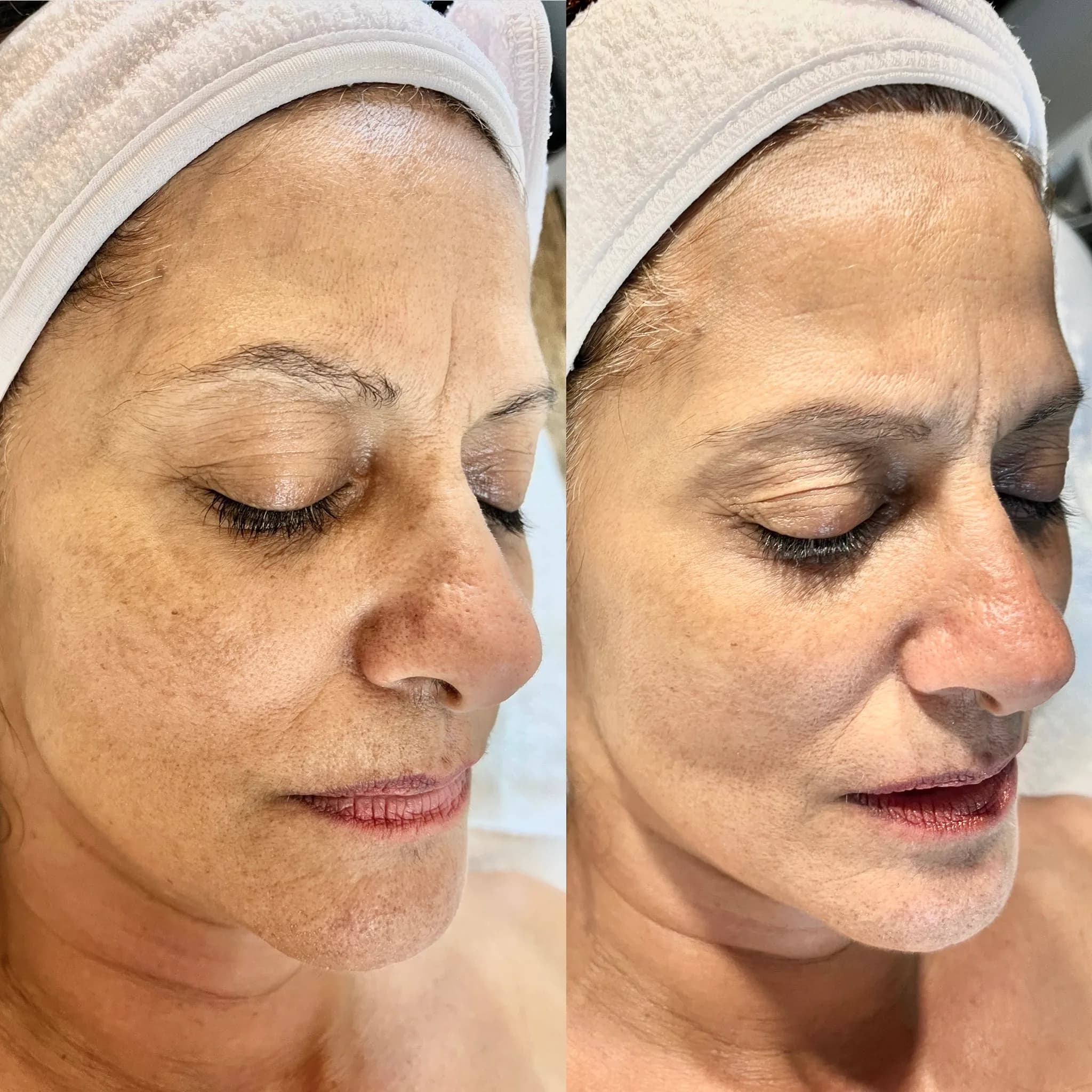 Before and after of a holistic facial by Nikolle, transformation I