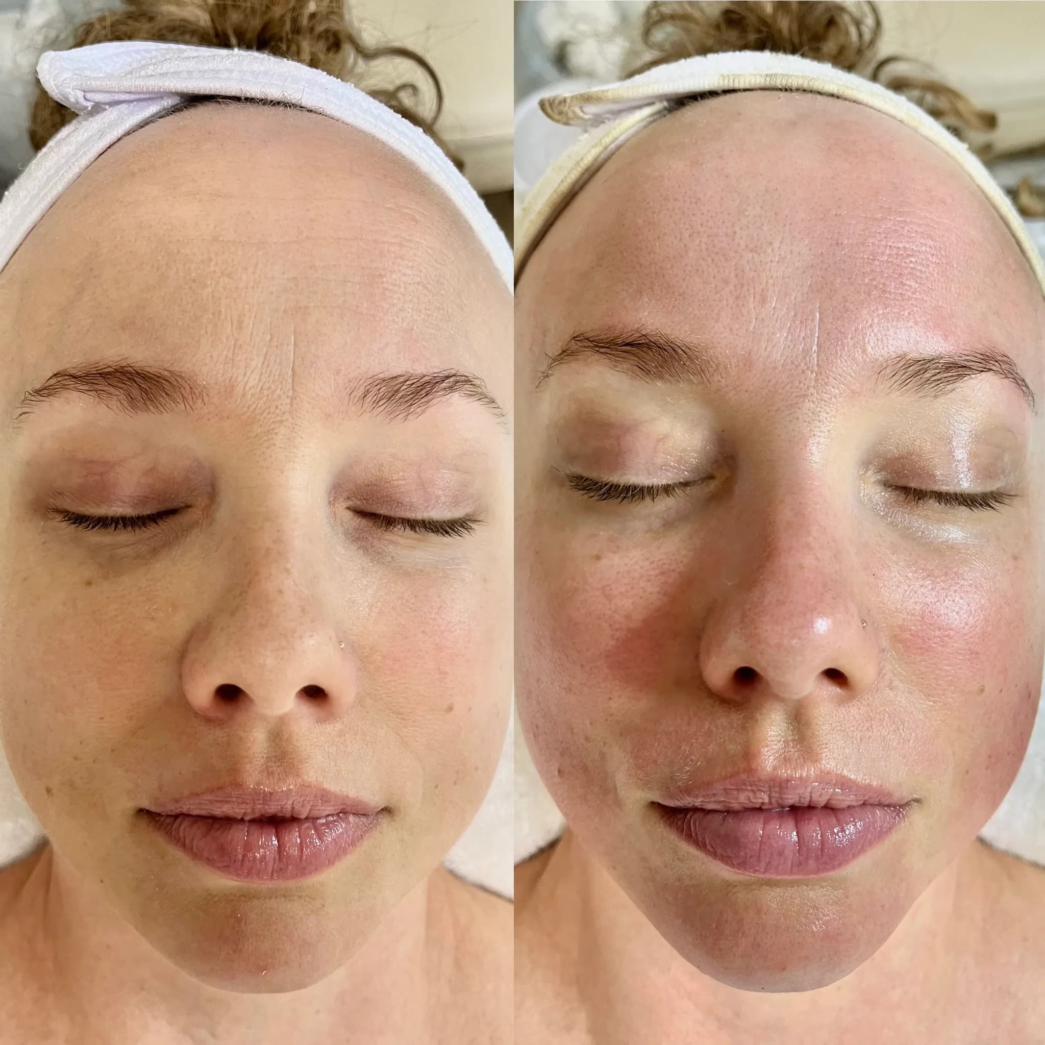 Before and after of a holistic facial by Nikolle, transformation II