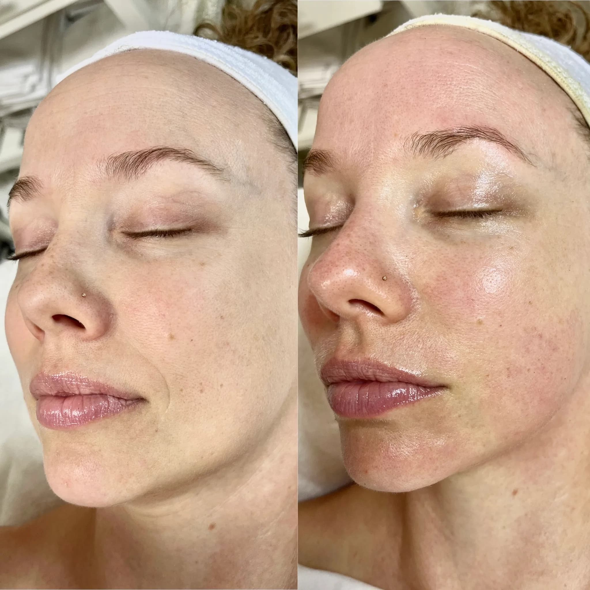 Before and after of a holistic facial by Nikolle, transformation III