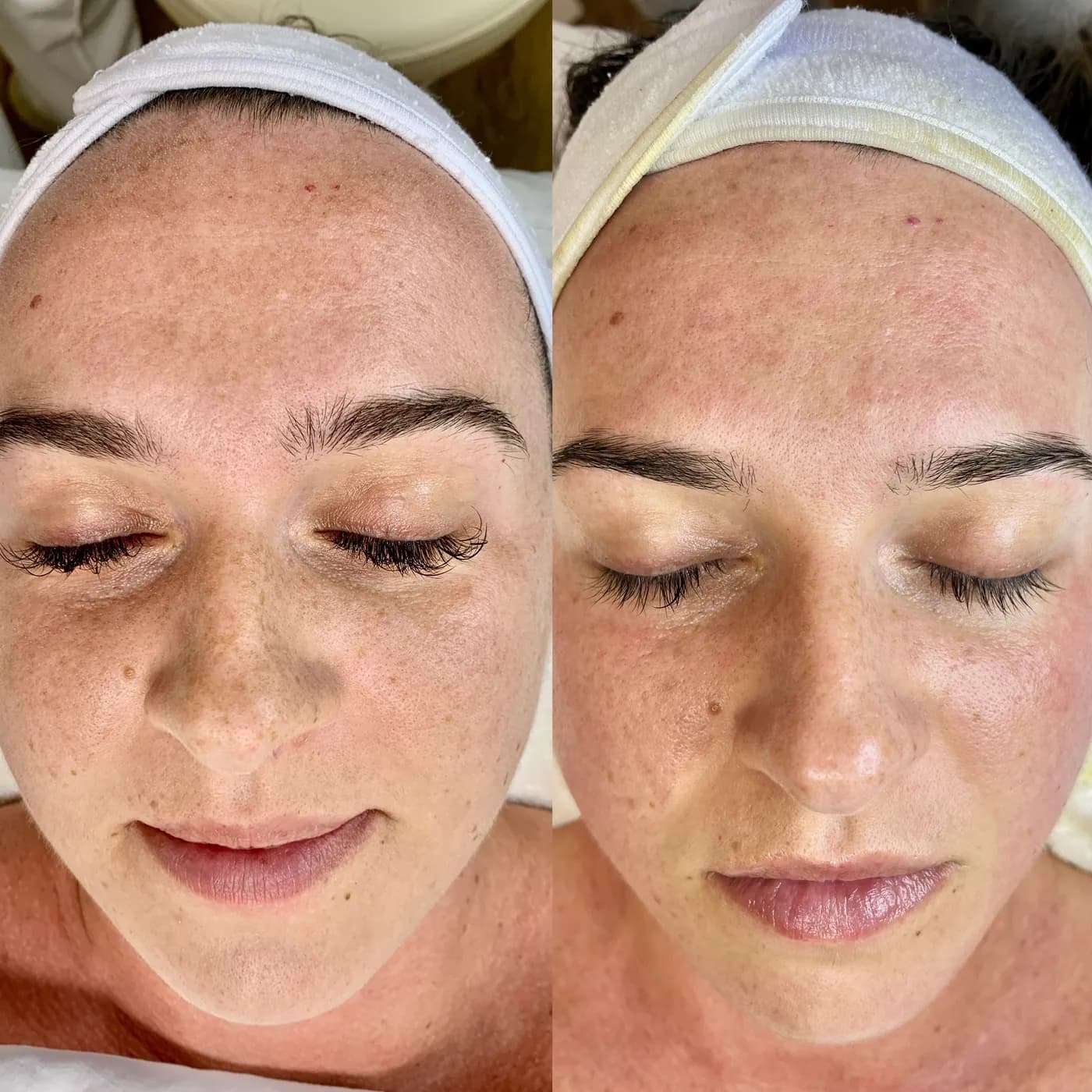 Before and after of a holistic facial by Nikolle, transformation IV