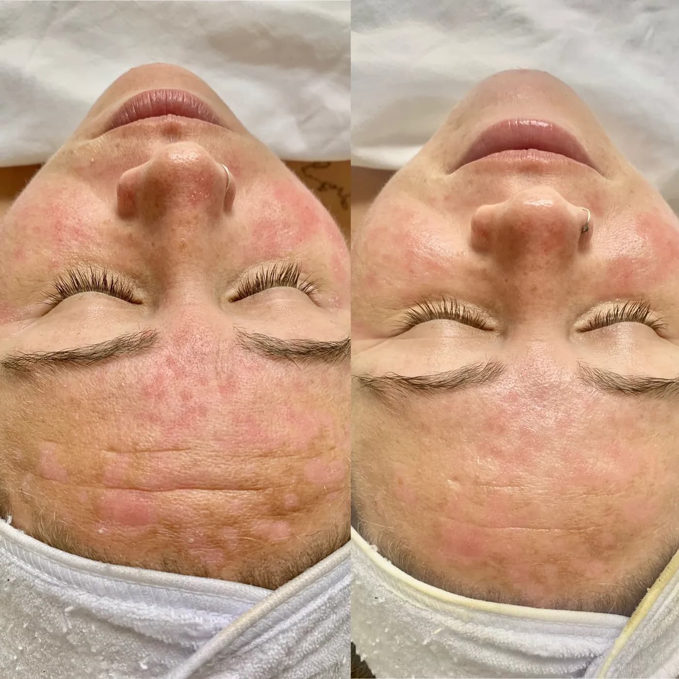 Before and after of a holistic facial by Nikolle, transformation V